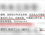 2023年医美维权案例：徐汇区检察院调查胸部养护中心资质与效果争议