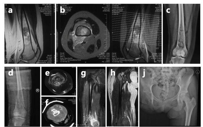 女孩高考晕倒确诊骨癌！自己签字进行6次手术截肢，上海医生全力救治__女孩高考晕倒确诊骨癌！自己签字进行6次手术截肢，上海医生全力救治